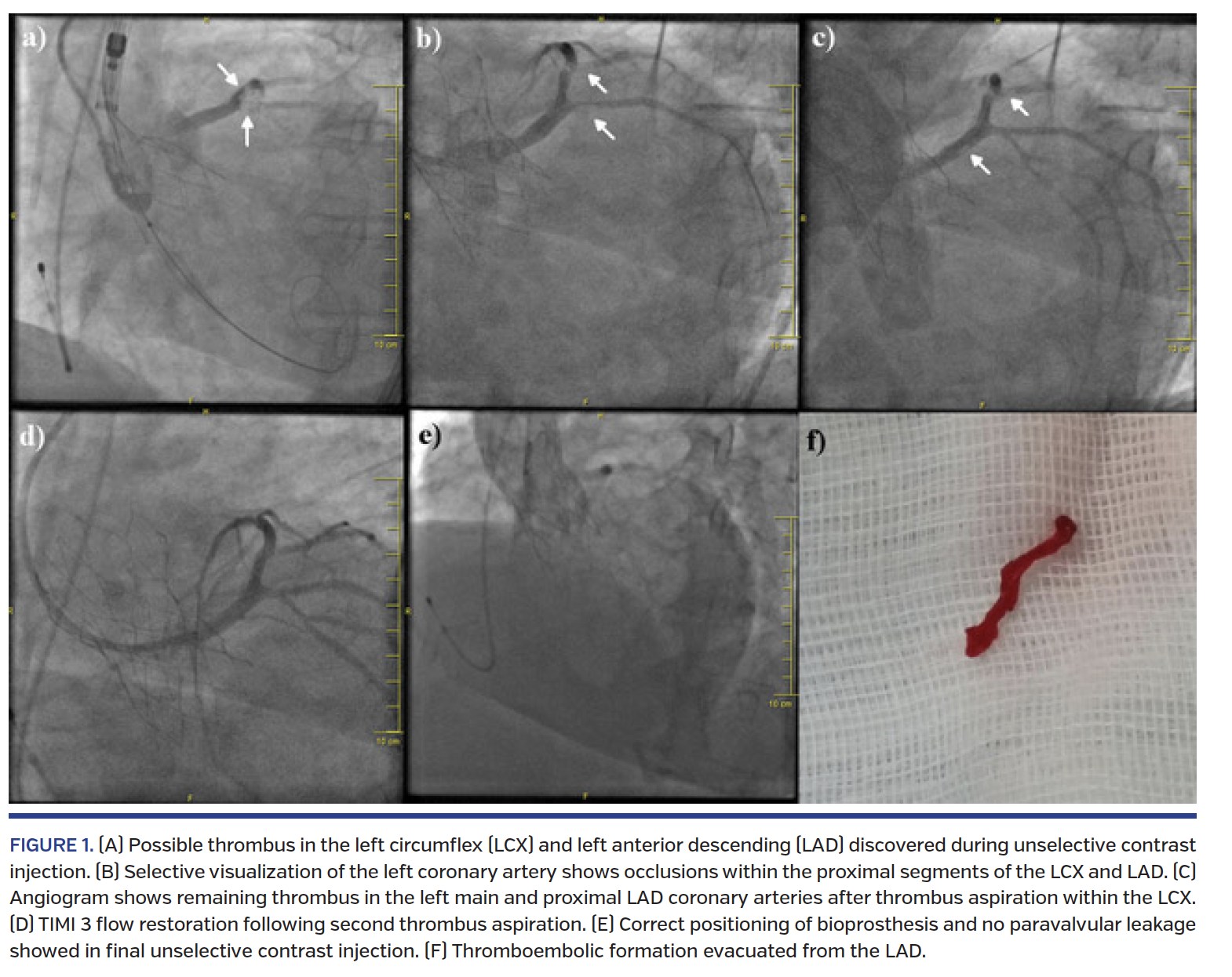 Possible thrombus in the left circumflex (LCX) and left anterior descending (LAD)