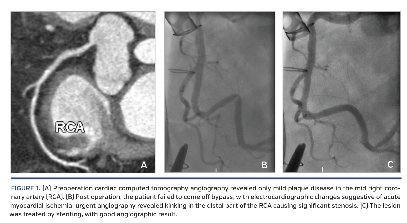 Preoperation cardiac computed tomography angiography revealed only mild plaque disease in the mid right coronary artery