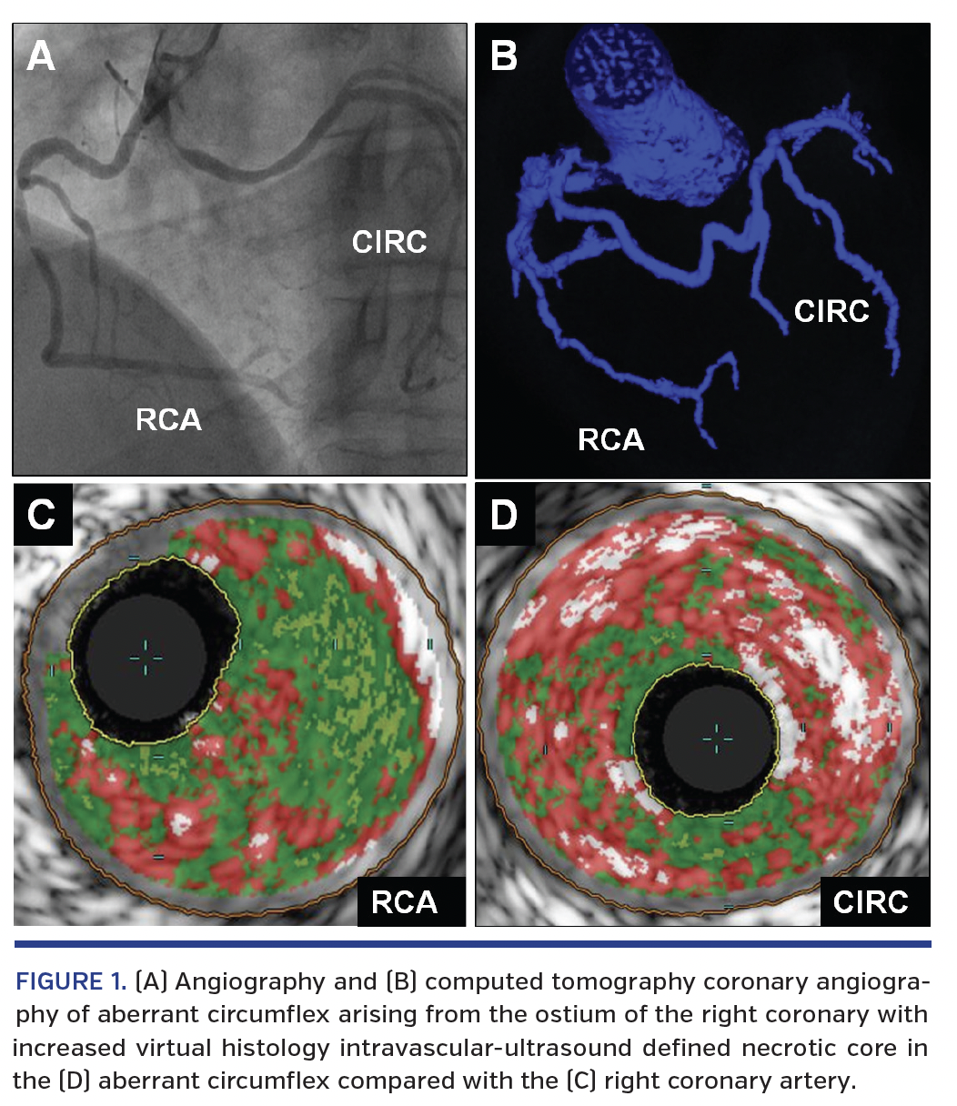 FIGURE 1. (A) Angiography and (B) computed tomography coronary angiography of aberrant circumflex arising from the ostium of the right coronary with increased virtual histology intravascular-ultrasound defined necrotic core in the (D) aberrant circumflex compared with the (C) right coronary artery.