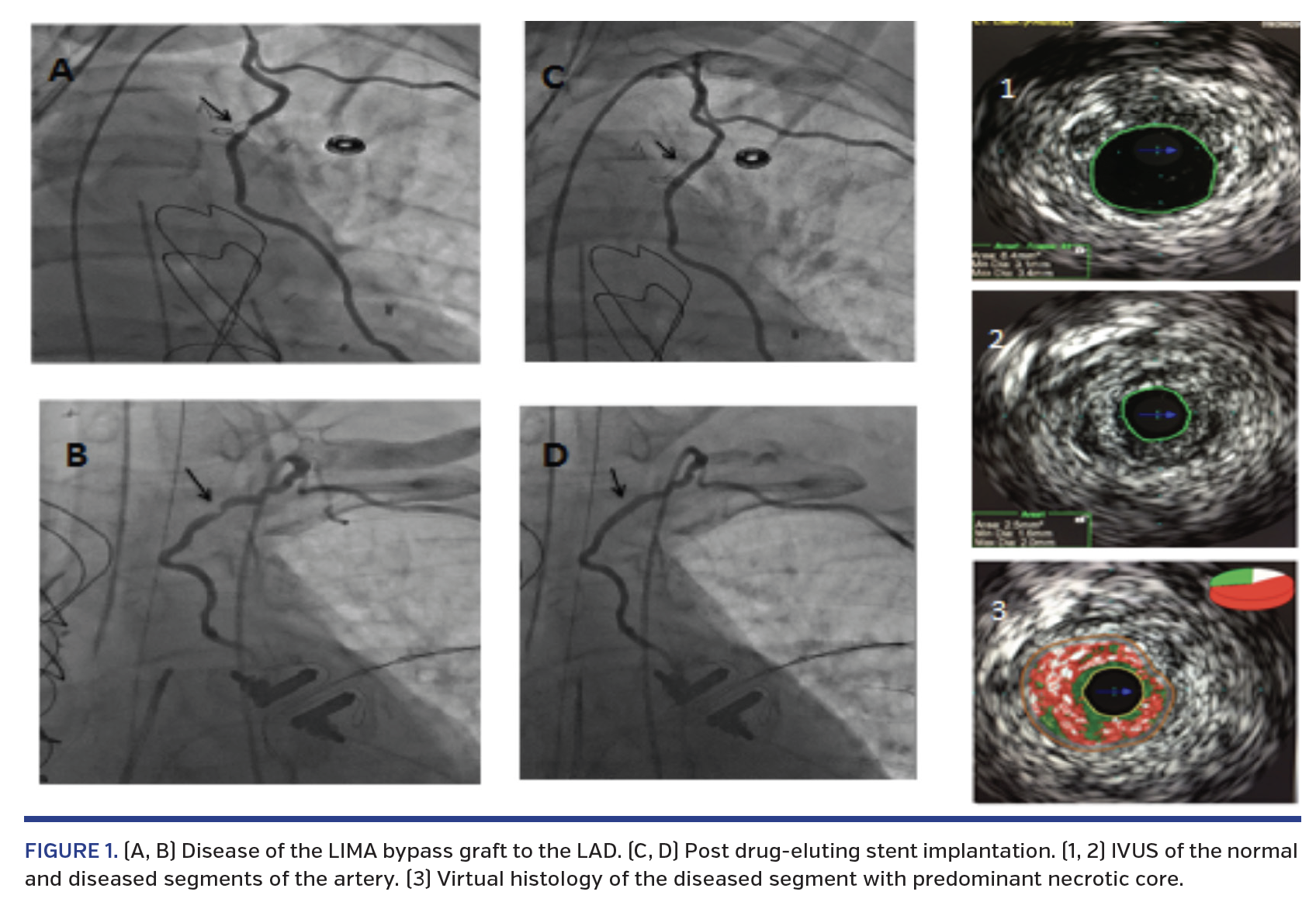FIGURE 1. (A, B) Disease of the LIMA bypass graft to the LAD. (C, D) Post drug-eluting stent implantation. (1, 2) IVUS of the normal and diseased segments of the artery. (3) Virtual histology of the diseased segment with predominant necrotic core.