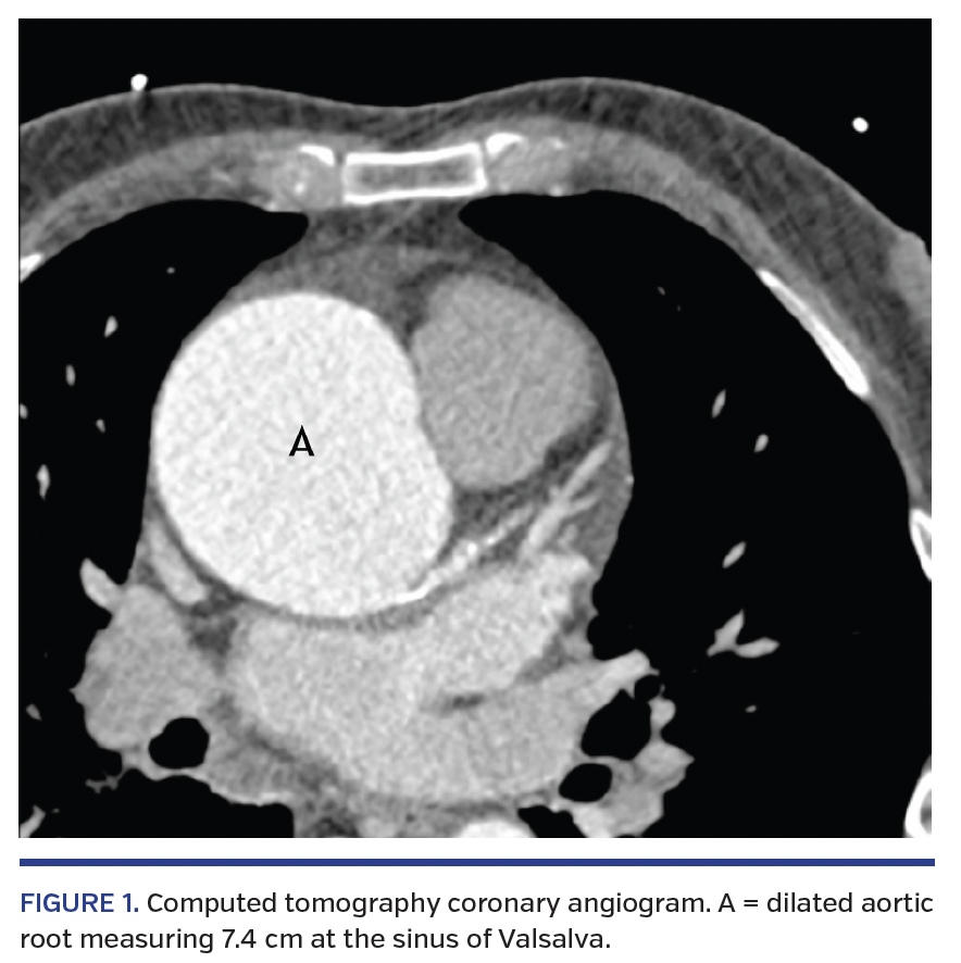 FIGURE 1. Computed tomography coronary angiogram. A = dilated aortic root measuring 7.4 cm at the sinus of Valsalva.