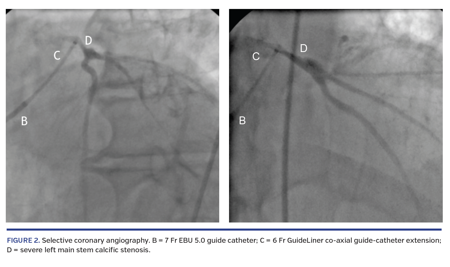FIGURE 2. Selective coronary angiography. B = 7 Fr EBU 5.0 guide catheter; C = 6 Fr GuideLiner co-axial guide-catheter extension; D = severe left main stem calcific stenosis.