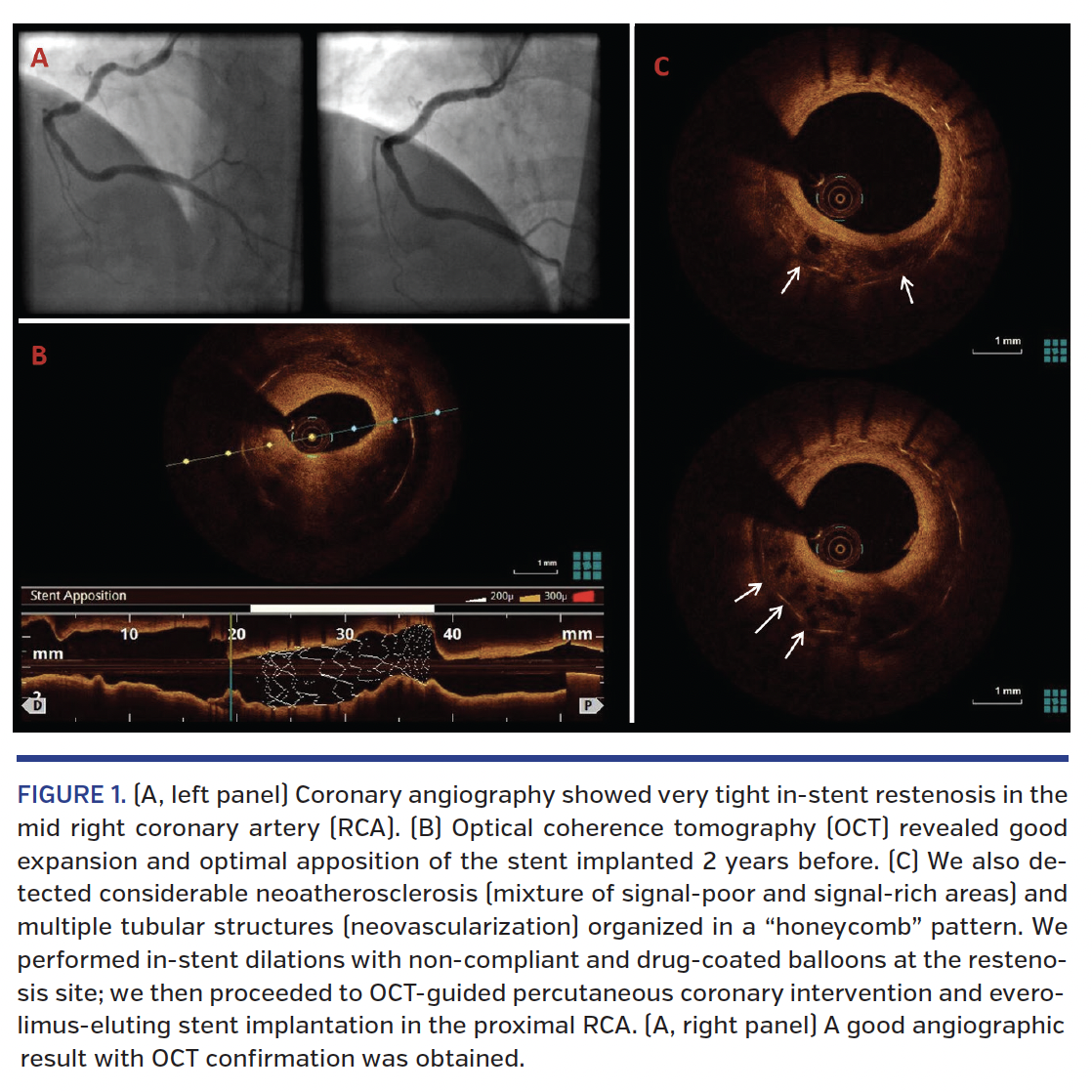FIGURE 1. (A, left panel) Coronary angiography showed very tight in-stent restenosis in the mid right coronary artery (RCA