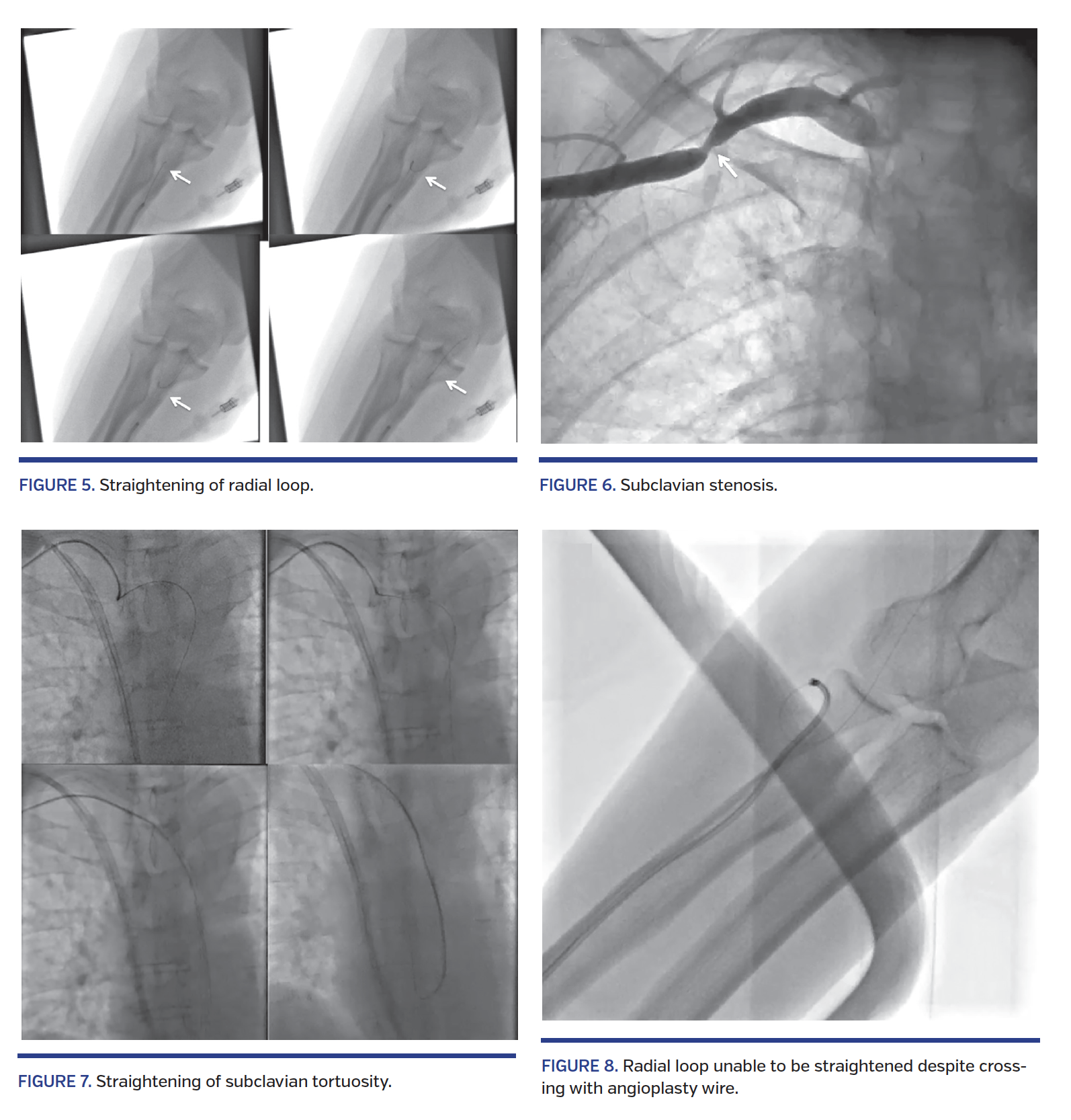 Straightening of radial loop.