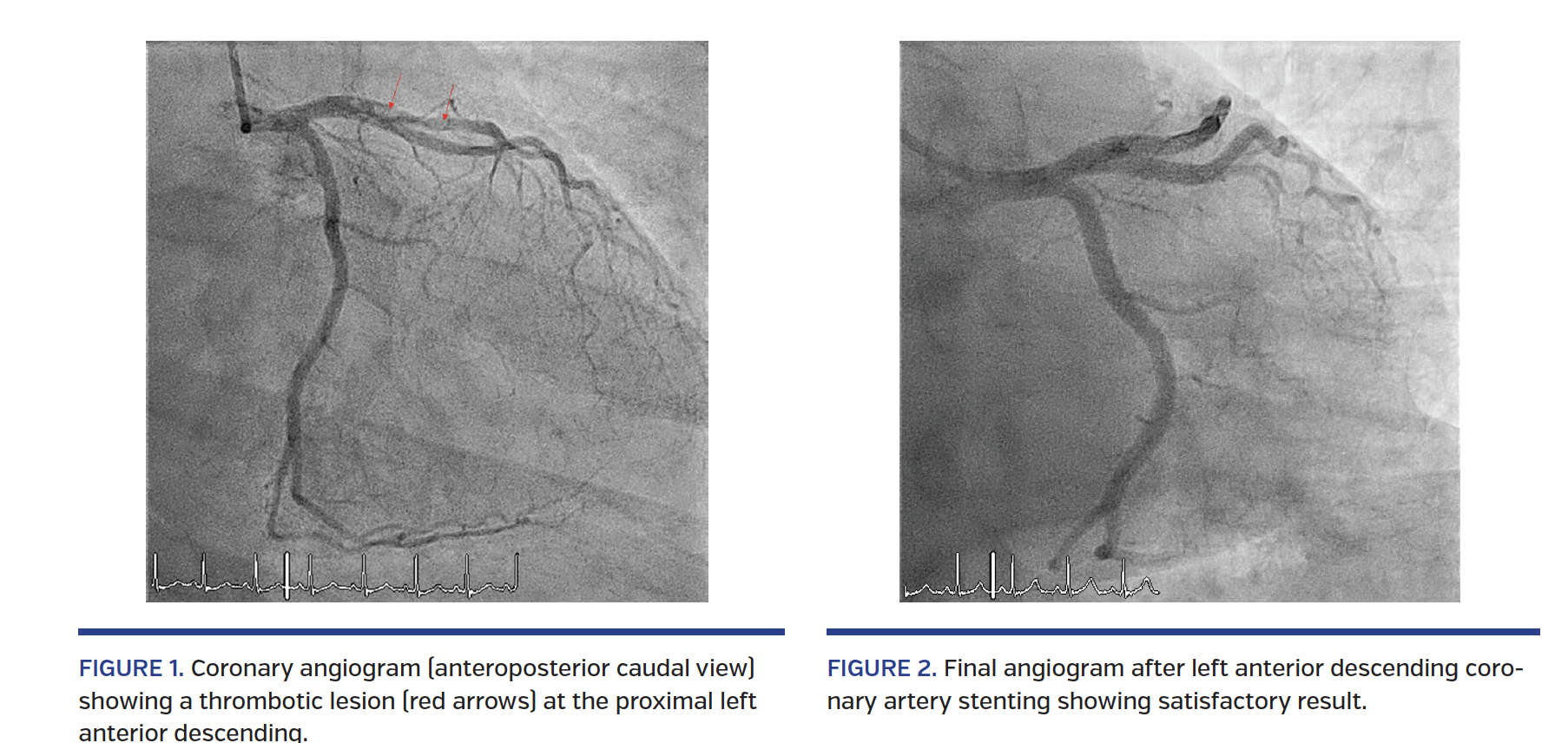 FIGURE 1. Coronary angiogram (anteroposterior caudal view) showing a thrombotic lesion (red arrows) at the proximal left anterior descending. FIGURE 2. Final angiogram after left anterior descending coronary artery stenting showing satisfactory result.