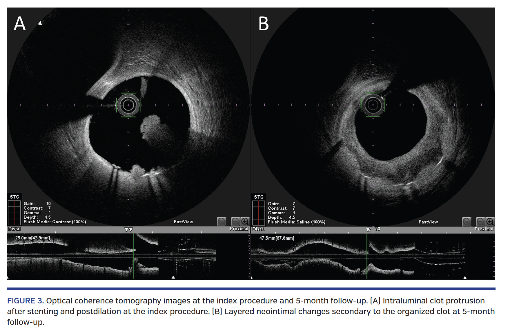 FIGURE 3. Optical coherence tomography images at the index procedure and 5-month follow-up. (A) Intraluminal clot protrusion after stenting and postdilation at the index procedure. (B) Layered neointimal changes secondary to the organized clot at 5-month follow-up.