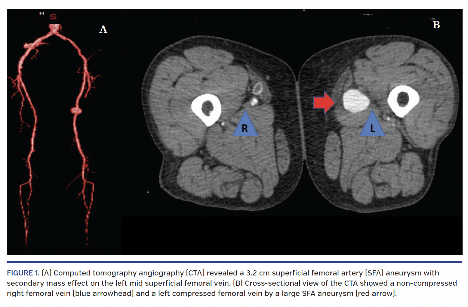 FIGURE 1. (A) Computed tomography angiography (CTA) revealed a 3.2 cm superficial femoral artery (SFA) aneurysm with secondary mass effect on the left mid superficial femoral vein. (B) Cross-sectional view of the CTA showed a non-compressed right femoral vein (blue arrowhead) and a left compressed femoral vein by a large SFA aneurysm (red arrow).