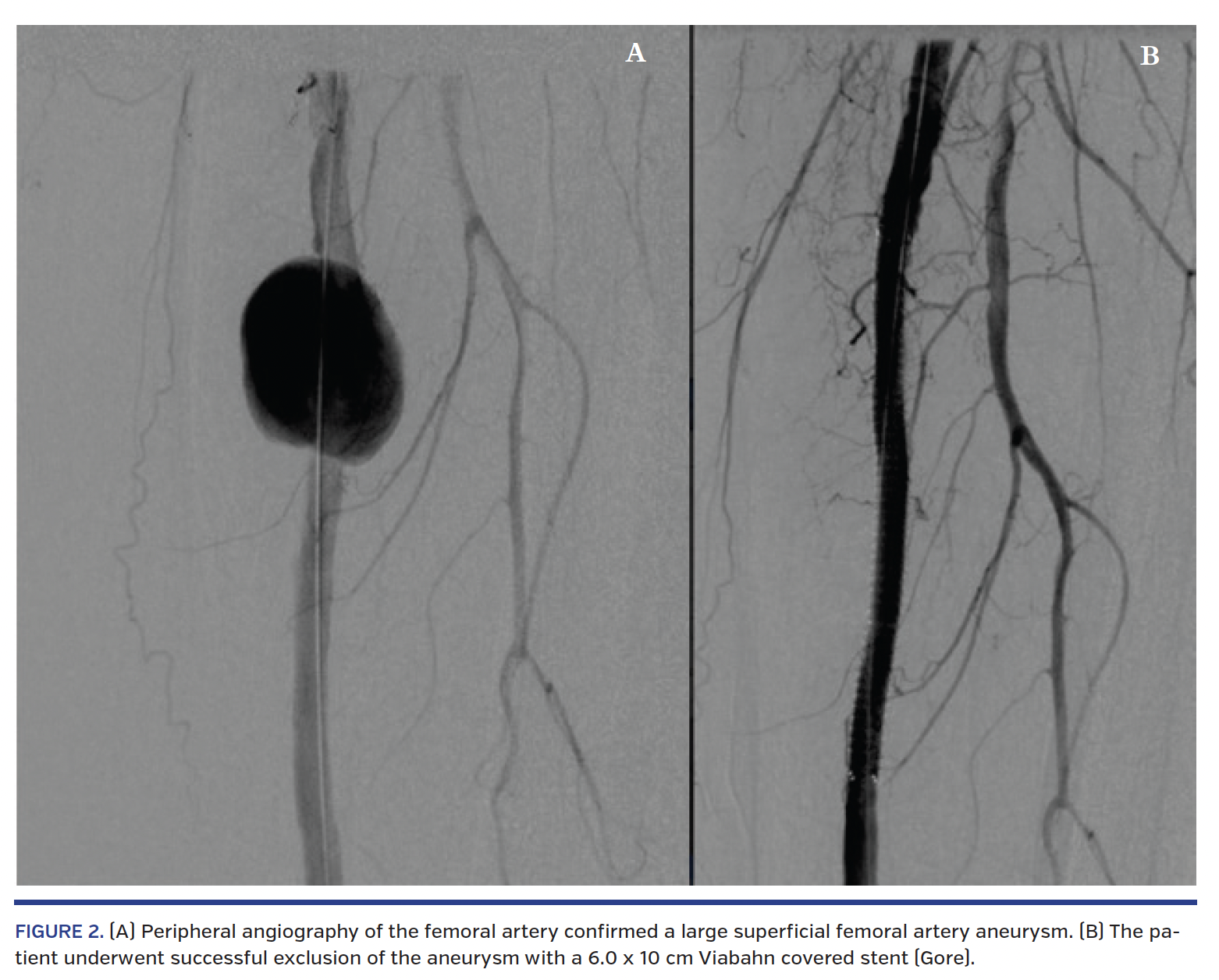 FIGURE 2. (A) Peripheral angiography of the femoral artery confirmed a large superficial femoral artery aneurysm. (B) The patient underwent successful exclusion of the aneurysm with a 6.0 x 10 cm Viabahn covered stent (Gore).