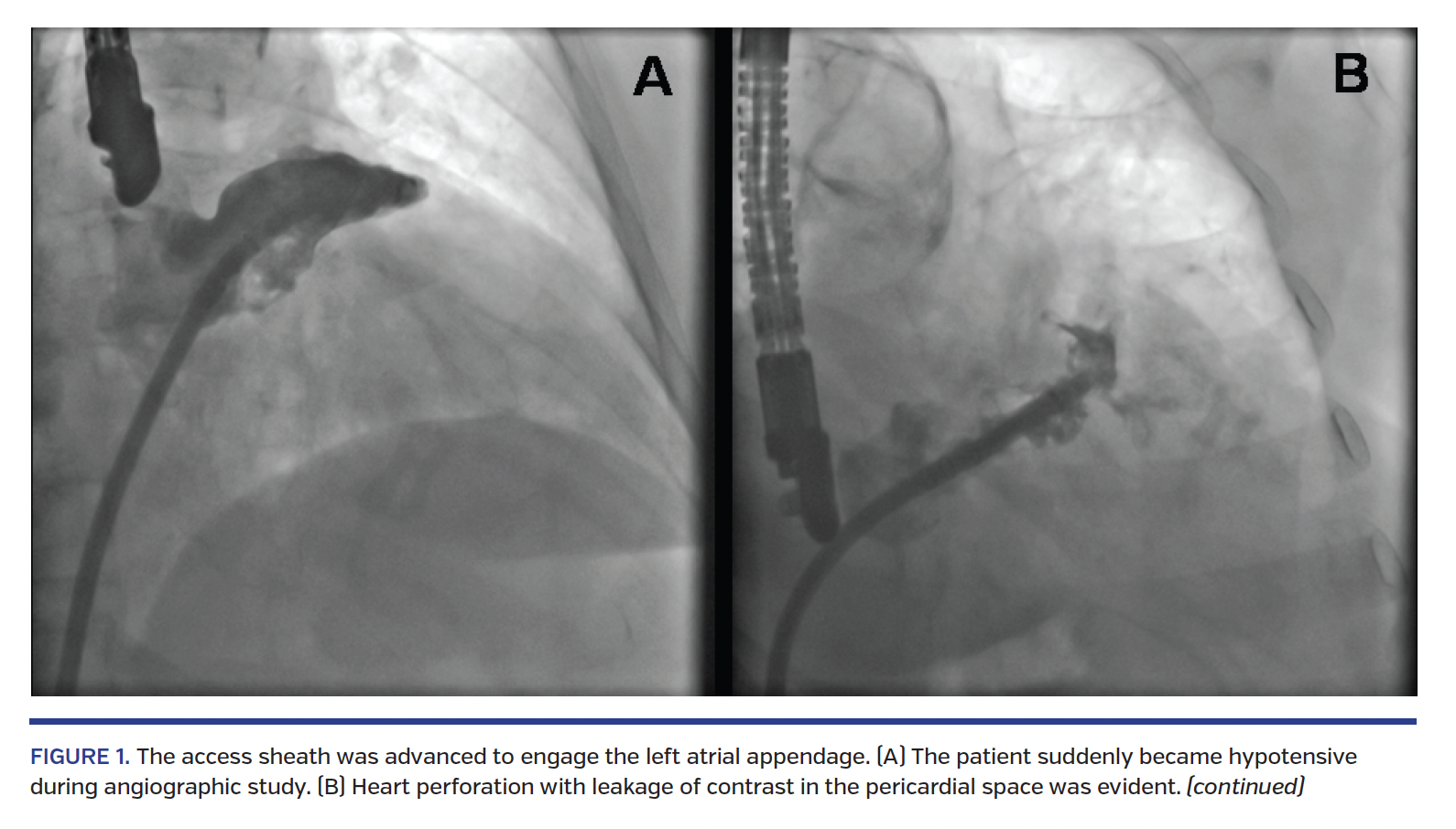 FIGURE 1. The access sheath was advanced to engage the left atrial appendage. (A) The patient suddenly became hypotensive during angiographic study. (B) Heart perforation with leakage of contrast in the pericardial space was evident. (continued)