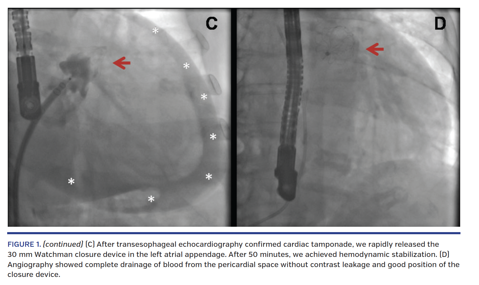 FIGURE 1. (continued) (C) After transesophageal echocardiography confirmed cardiac tamponade, we rapidly released the 30 mm Watchman closure device in the left atrial appendage. After 50 minutes, we achieved hemodynamic stabilization. (D) Angiography showed complete drainage of blood from the pericardial space without contrast leakage and good position of the closure device.