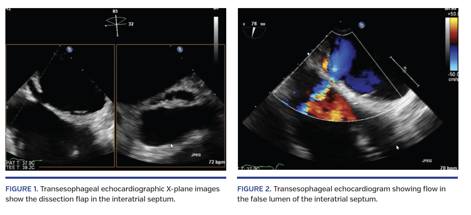 Transesophageal echocardiographic X-plane images