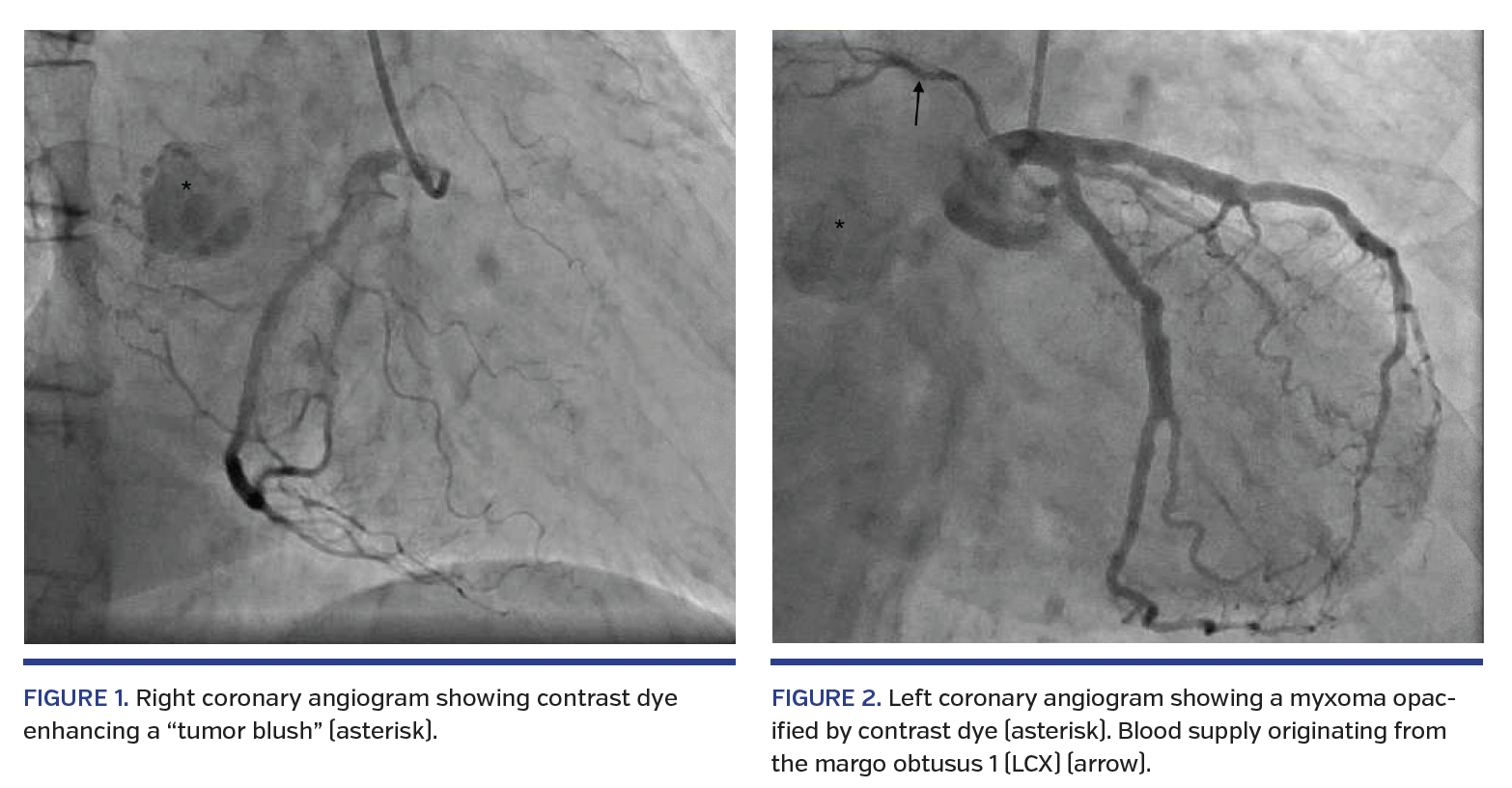 coronary angiogram