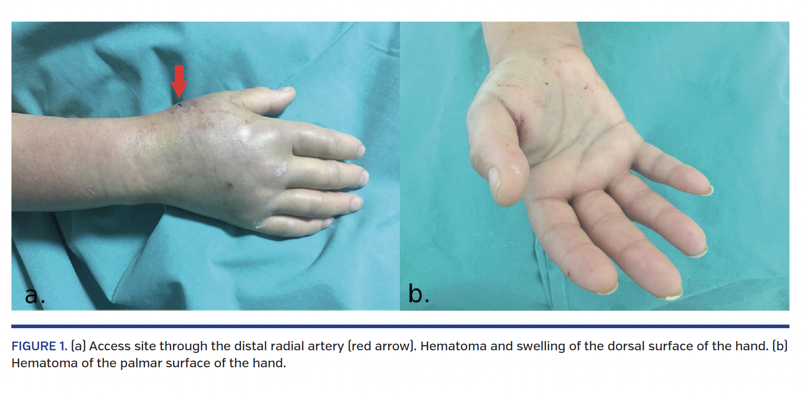 FIGURE 1. (a) Access site through the distal radial artery (red arrow). Hematoma and swelling of the dorsal surface of the hand. (b) Hematoma of the palmar surface of the hand.