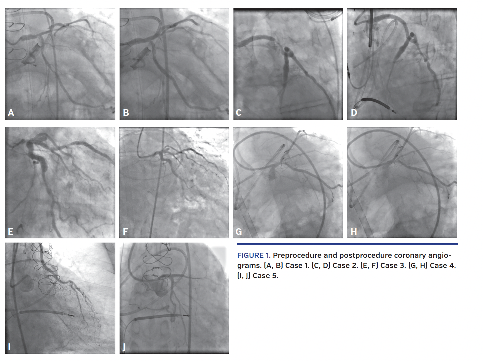 FIGURE 1. Preprocedure and postprocedure coronary angiograms. (A, B) Case 1. (C, D) Case 2. (E, F) Case 3. (G, H) Case 4. (I, J) Case 5.