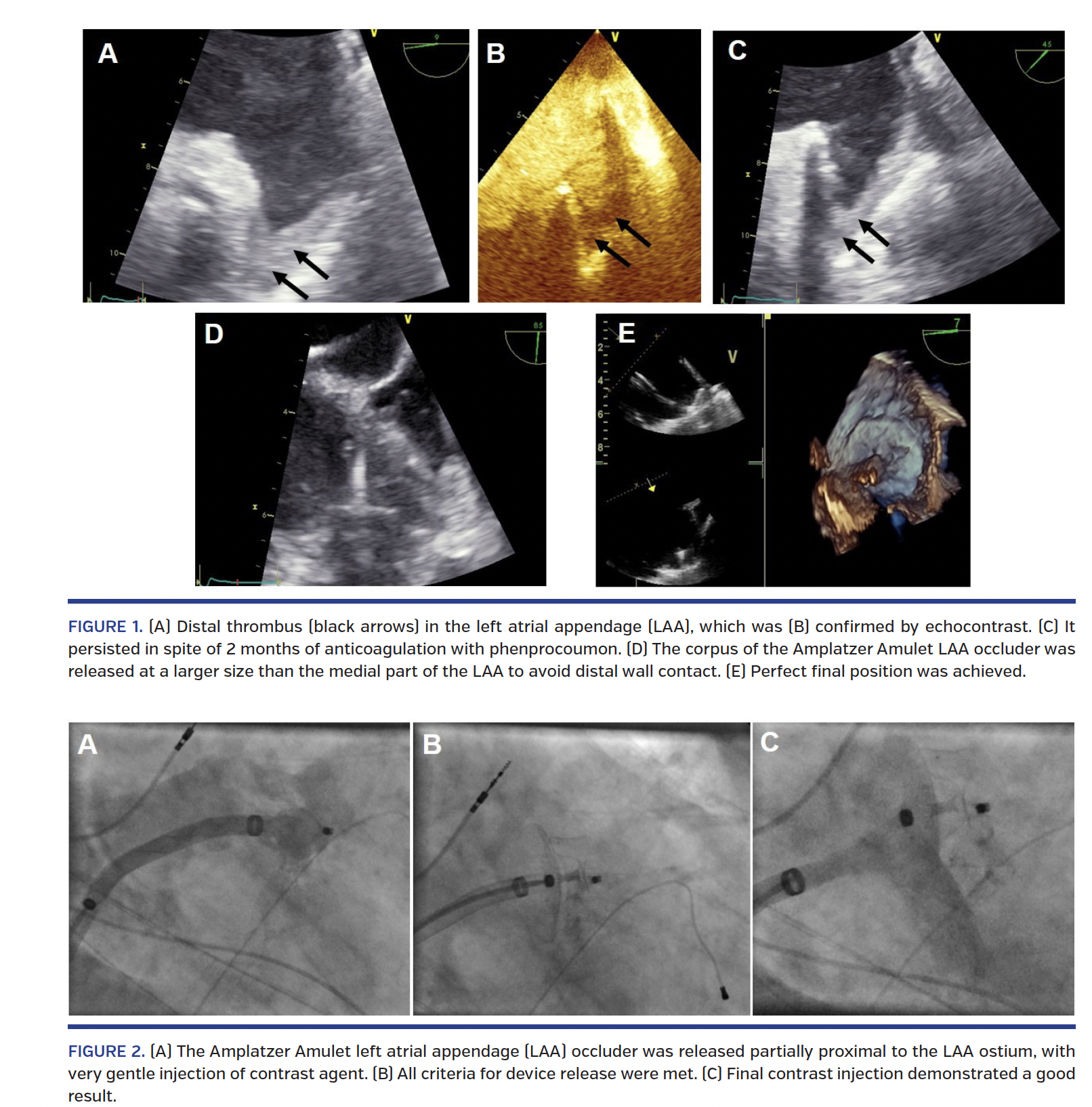 left atrial appendage