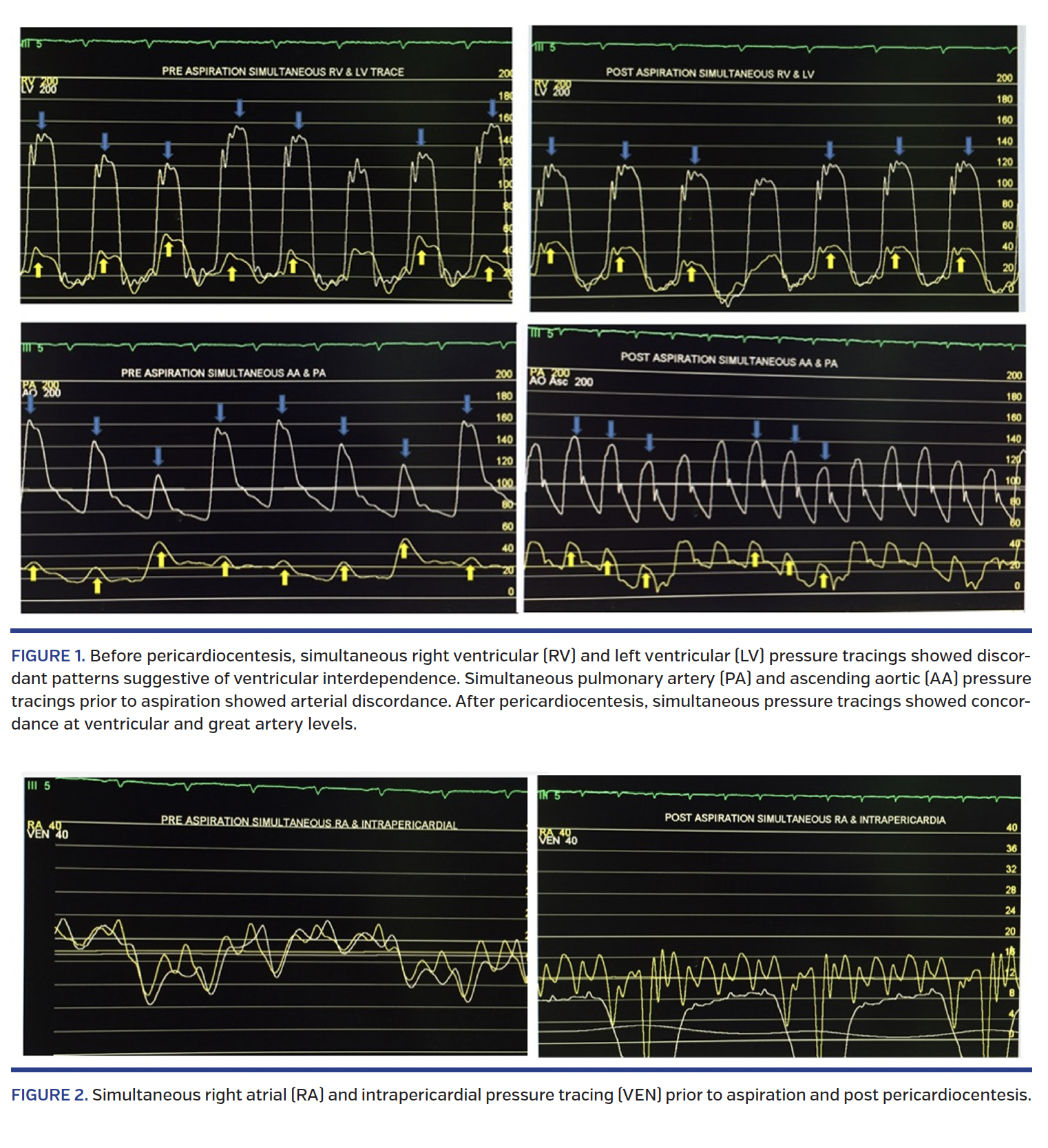 Arterial Discordance in Cardiac Tamponade