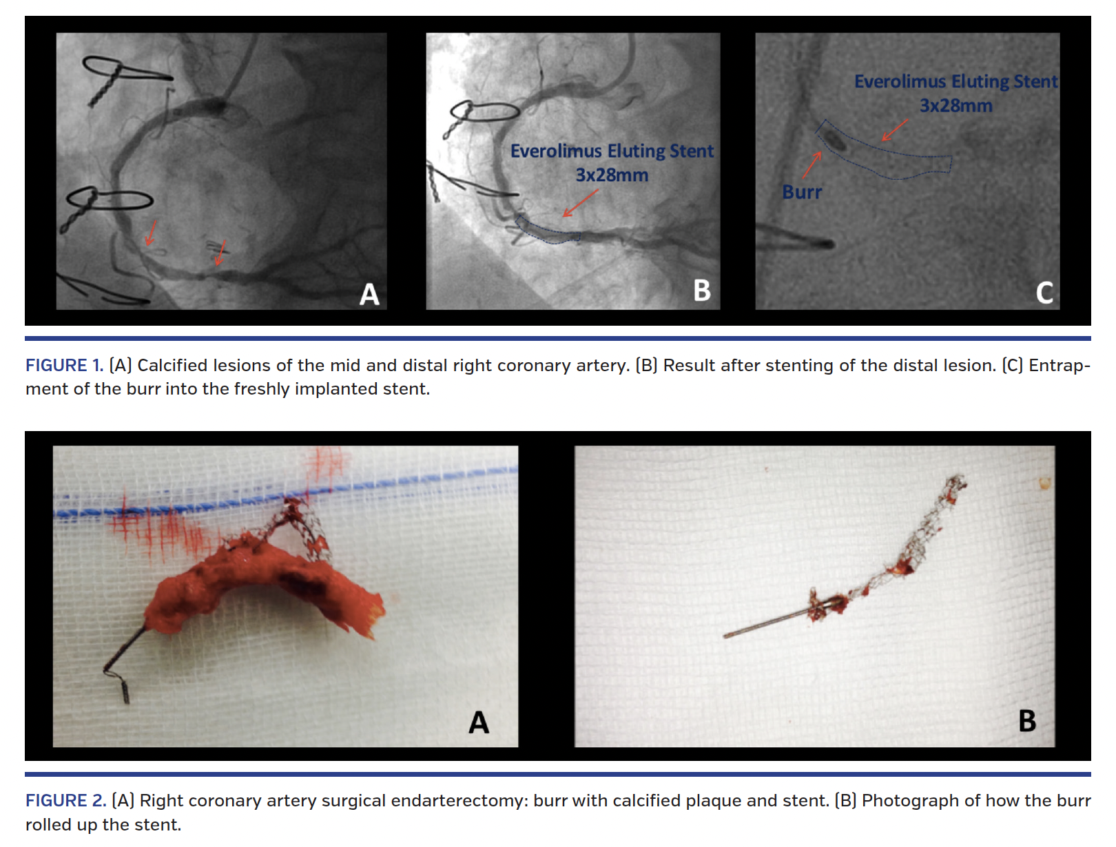 Entrapment of Rotational Atherectomy Burrs