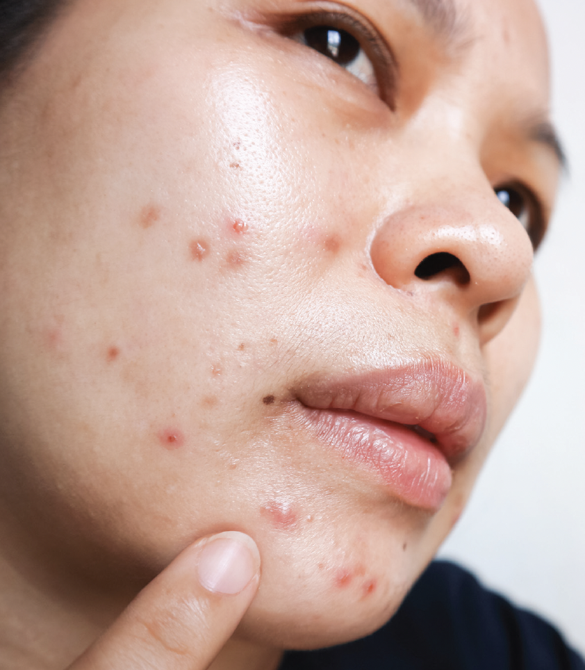 severe acne