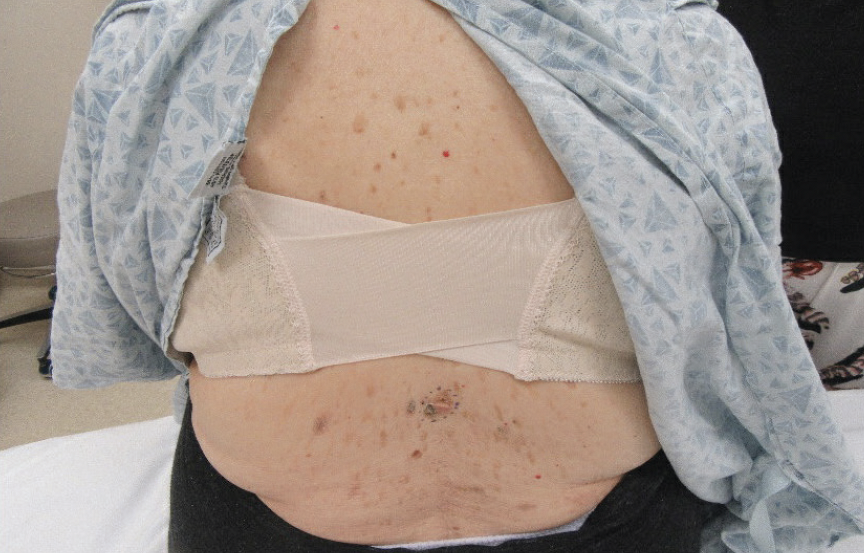 A skin-colored to pink pedunculated papule with surrounding brown crust was noted on the mid-lower back.