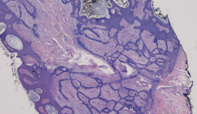 Figure 3. Histopathologic findings revealed tumor islands and anastomosing strands of basaloid, palisading cells residing in a fibromatous stroma.