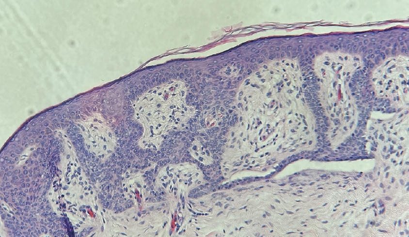 Figure 4. Palisading, columnar cells bordering the tumor islands, as well as clefts separating the fenestrations and stroma filled with mucin, were seen.