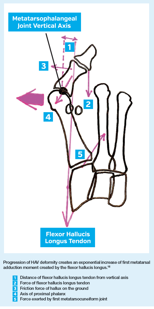 Progression of HAV deformity creates an exponential increase of first metatarsal adduction moment created by the flexor hallucis longus.16