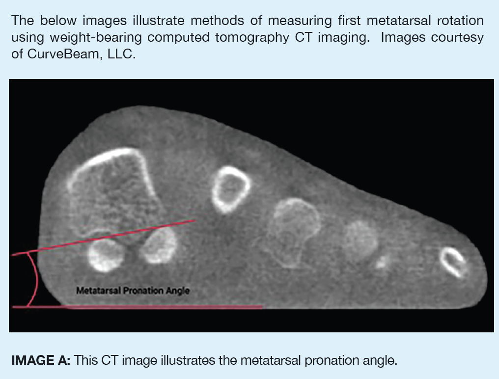 This CT image illustrates the metatarsal pronation angle.