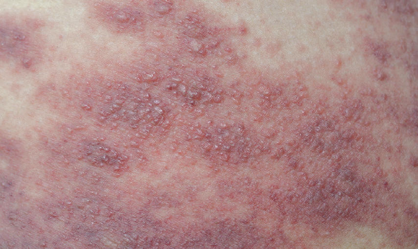severe atopic dermatitis