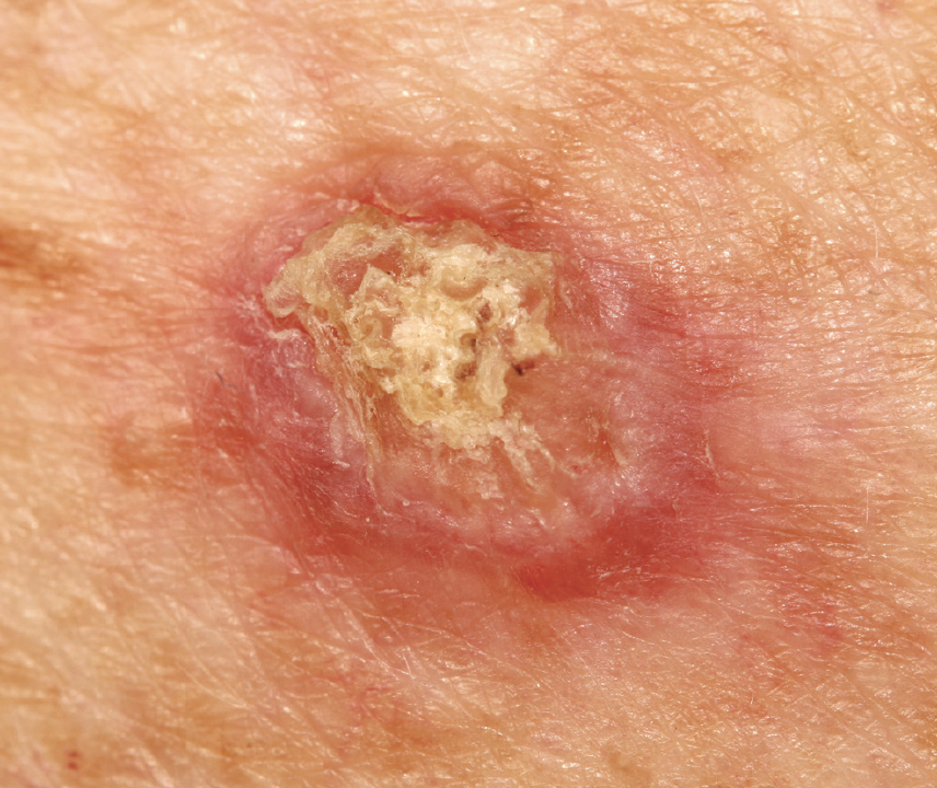 skin cancer tumor