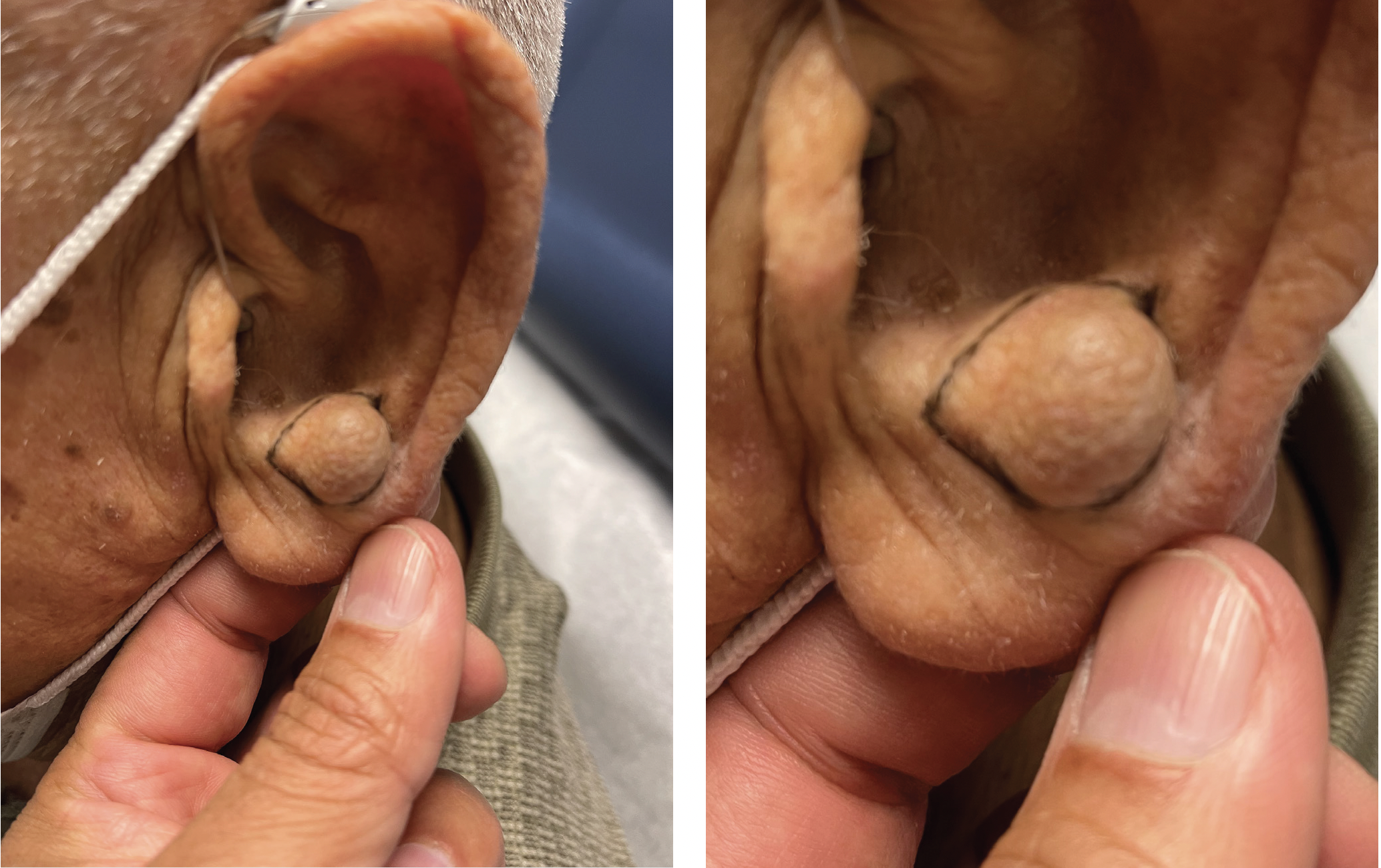 nodule on left antitragus