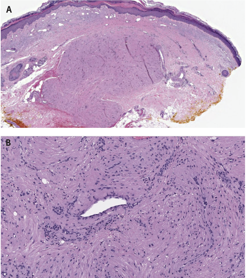 Proliferation of spindle cells with abundant eosinophilic cytoplasm