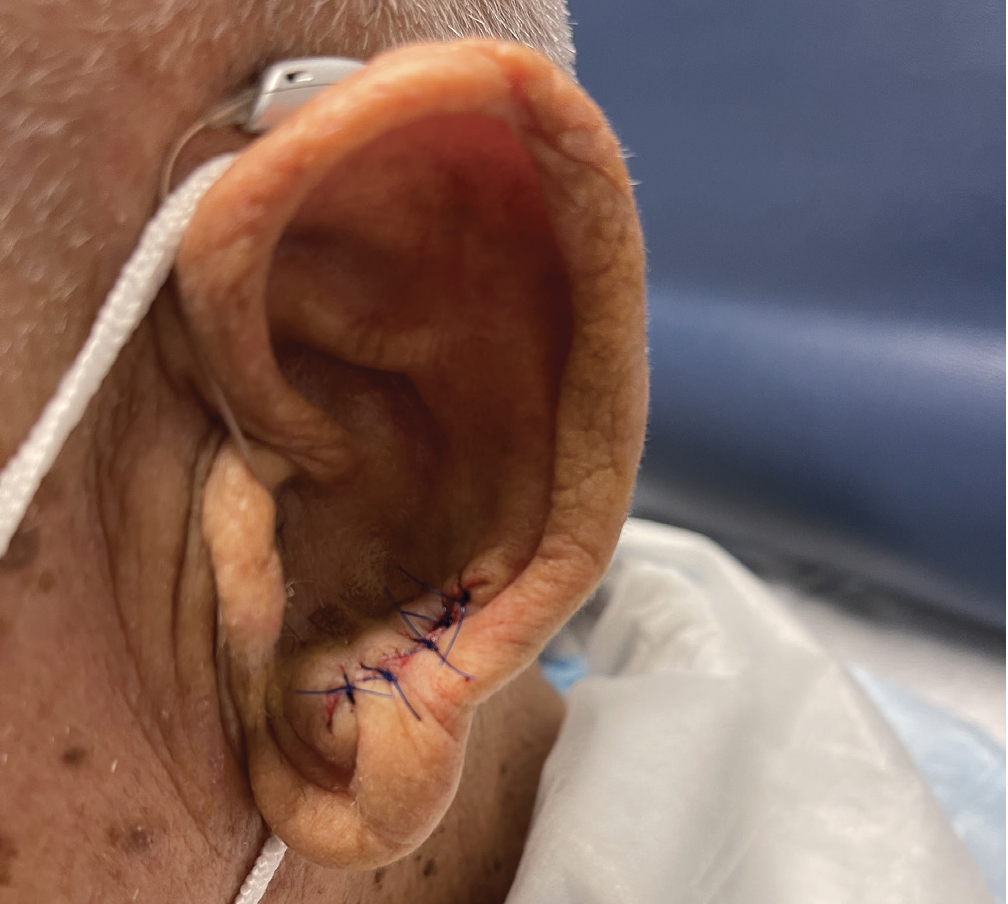 postsurgical removal of the lesion