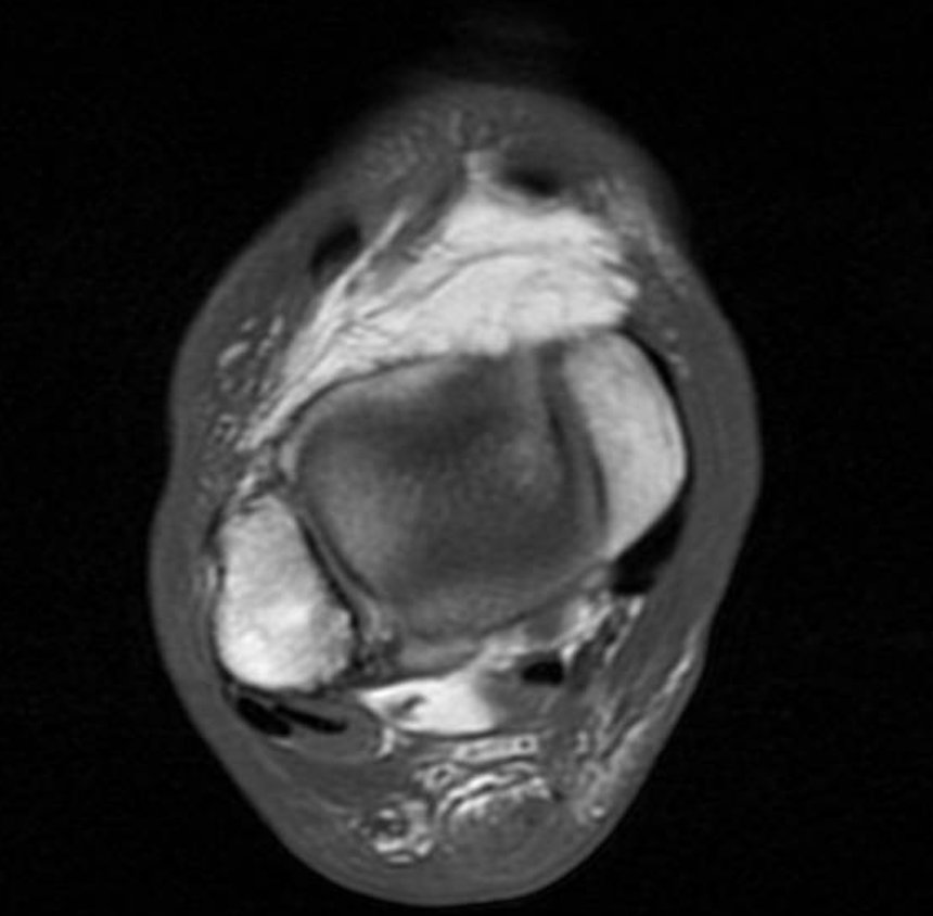 Additional R Achilles rupture