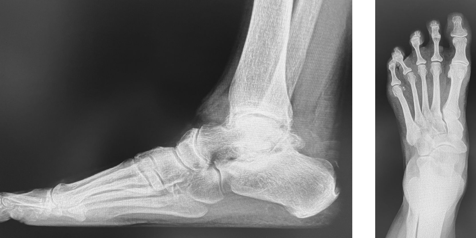 Pre-operative radiographs of the left foot and ankle 