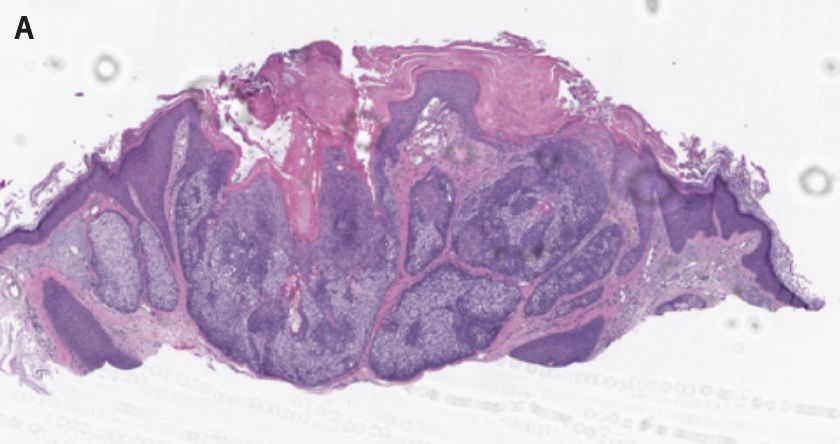 Well-circumscribed and lobular architecture with mature sebocytes
