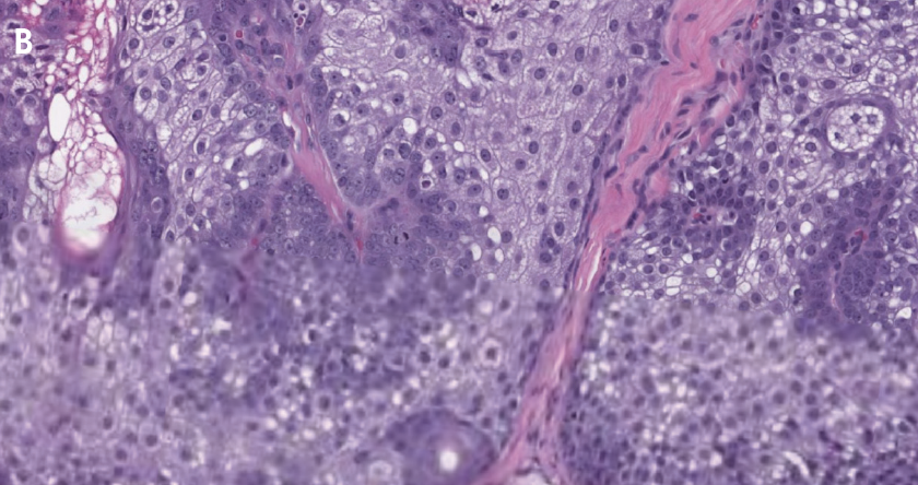 The biopsy specimen at 40x magnification