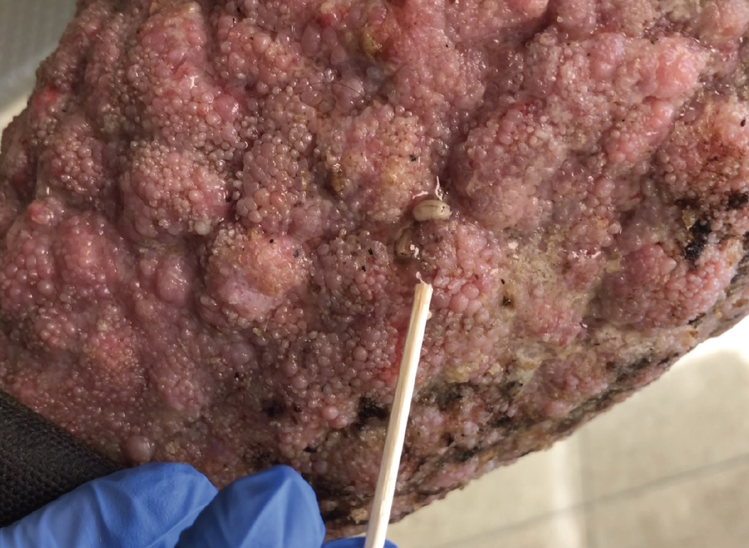 Figure 1. Multiple, oozing nodules and organisms on the patient’s right leg.