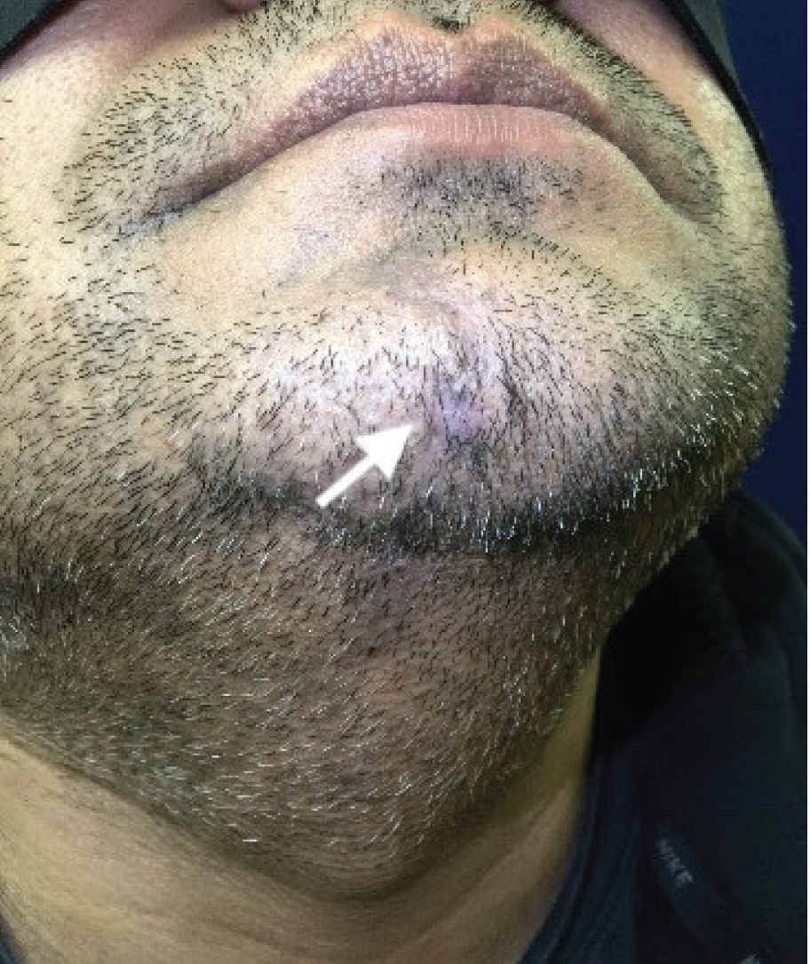 Figure 1. The white arrow demarcates the linear brown-gray atrophic patch on the anterior chin extending onto the neck.