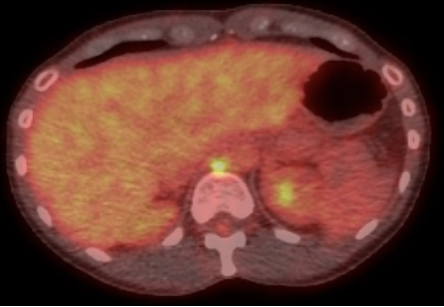 FIGURE 1. PET/CT with a solitary FDG-avid right retrocrural lymph node. No traditional access for image-guided biopsy and ablation was apparent.