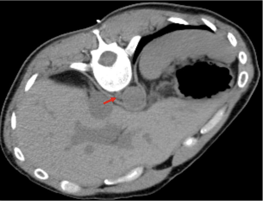 FIGURE 2. Initial axial noncontrast CT image from day of procedure. A red arrow points to the right retrocrural lymph node lesion, nestled anterior to the vertebral bone, and posterior to the aorta and liver.