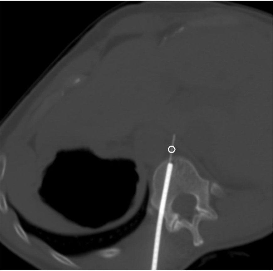 FIGURE 3. Intraprocedure axial noncontrast CT image shows 11-gauge bone access needle with a 22-gauge Chiba needle inserted coaxially for fine needle aspiration. A white circle marks the target retrocrural lymph node.