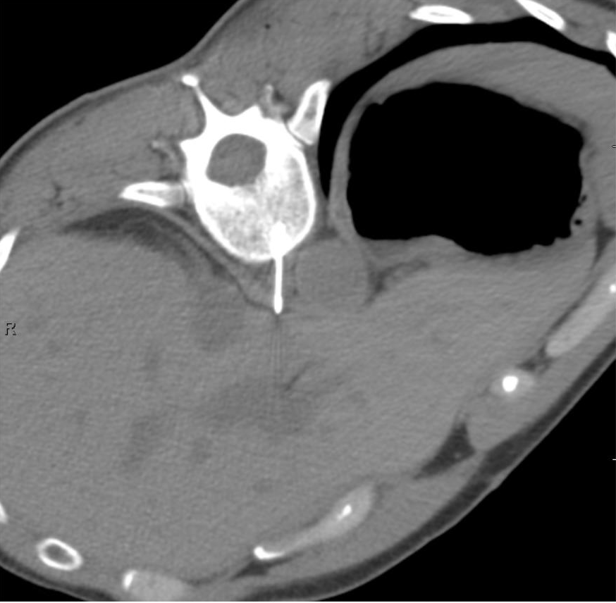 FIGURE 4. Intraprocedure axial noncontrast CT image shows an 18-gauge core needle biopsy device passed through the 11-gauge bone access needle, with sampling trough positioned across the target retrocrural lymph node.