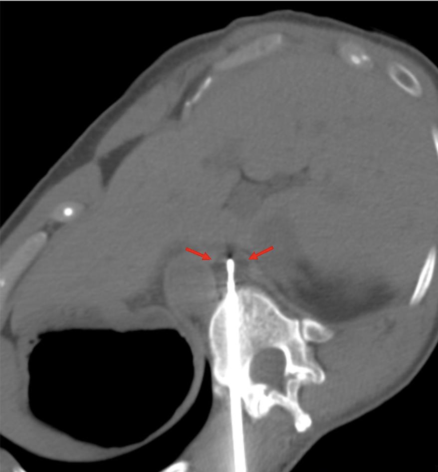 FIGURE 5. Intraprocedure axial noncontrast CT image shows the therapeutic ice ball during freeze cycle of cryoablation (red arrows). 