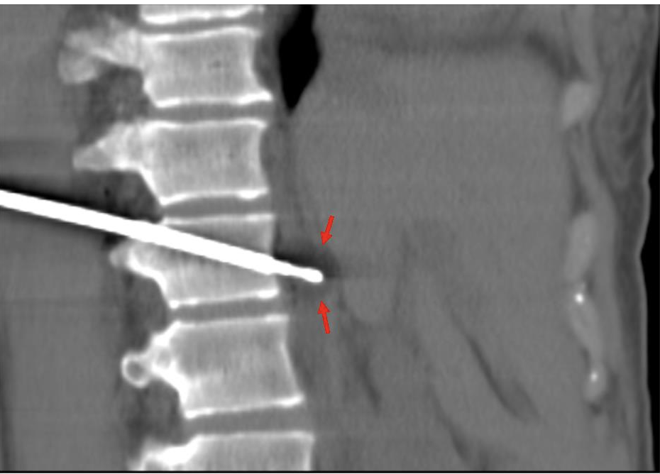 FIGURE 6. Intraprocedure oblique sagittal CT image shows ice ball during freeze cycle of cryoablation (red arrows).