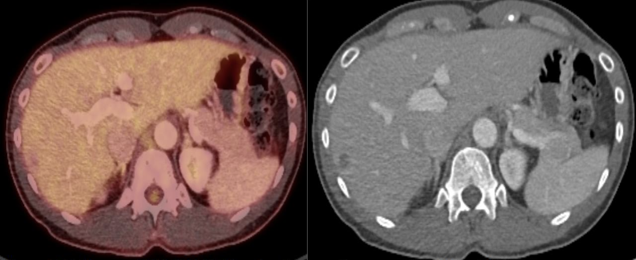 FIGURE 7. Follow-up FDG PET/CT fused and attenuation correction CT axial images demonstrated no residual FDG activity at the site of treated metastasis. Linear sclerosis is noted along the bone needle trajectory, consistent with osseous healing.