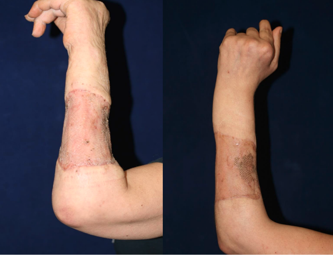 -	2.5 months after application of the split thickness skin graft -	Wound is closed