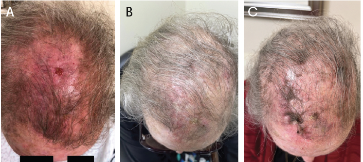 Figure. Timeline of scalp treatment