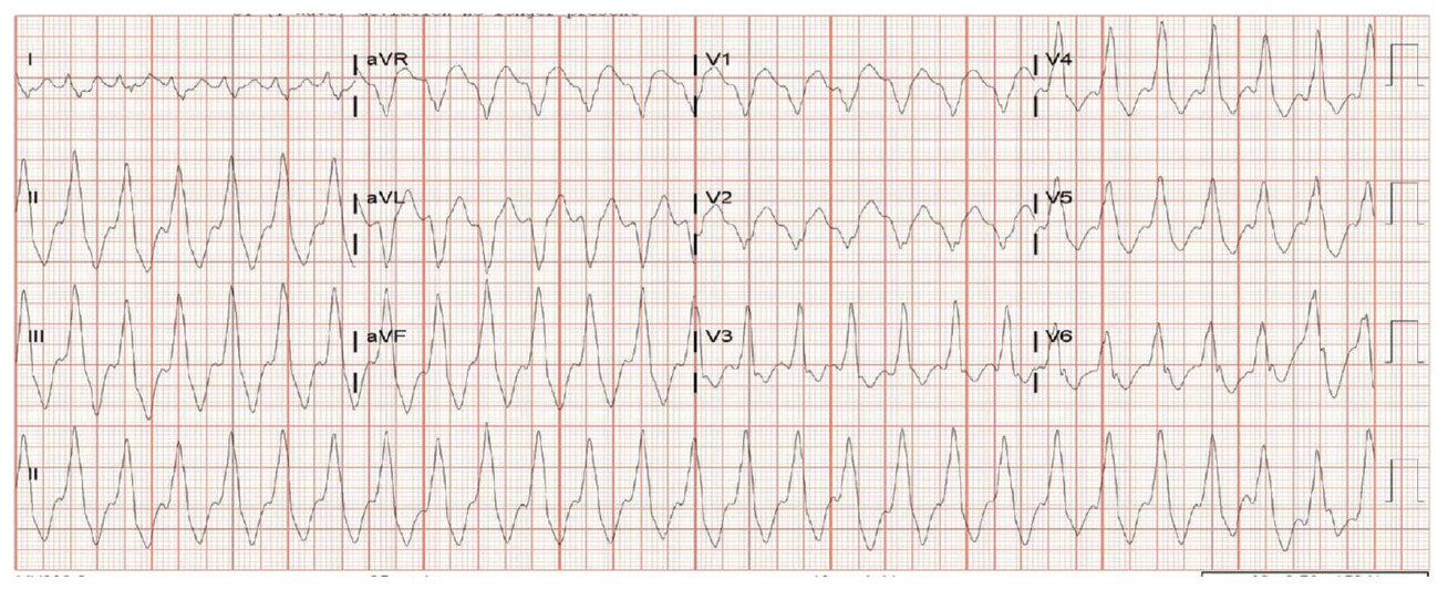 Figure 1. Wide-complex tachycardia at 180 bpm, with electrocardiographic confirmation of monomorphic ventricular tachycardia.