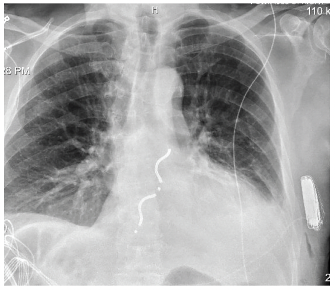 Figure 2. An Aurora EV-ICD (Medtronic) was implanted and the patient’s existing S-ICD system was removed.