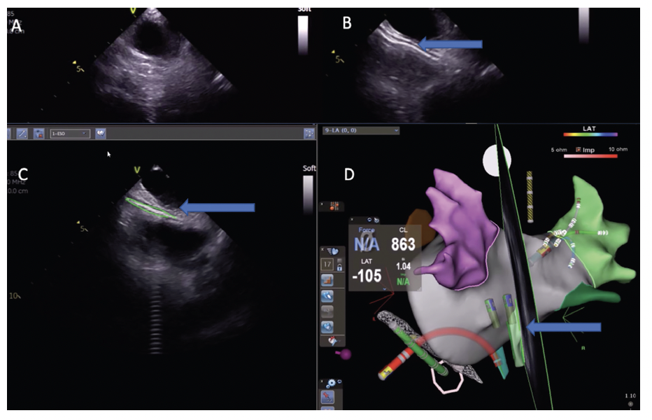 Figure 2. (A) Posterior LA on intracardiac ultrasound (B) with Definity injected into esophagus (C). Esophageal contour drawn (D) and visualized on the electroanatomical map. Arrow: esophagus.